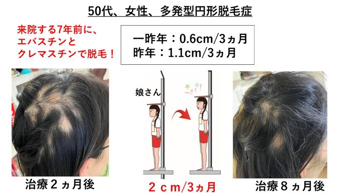 円形脱毛症　病院